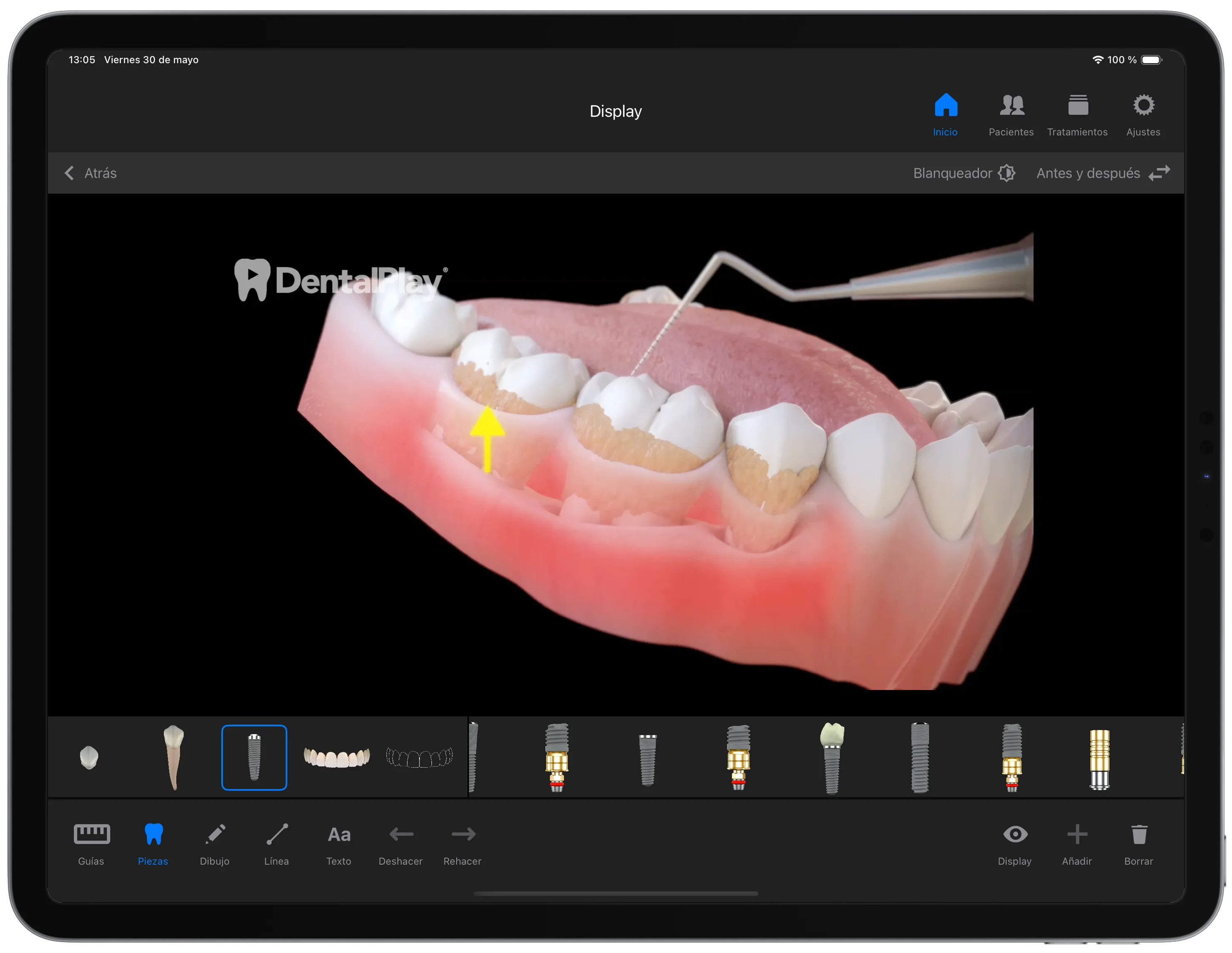 Dentool